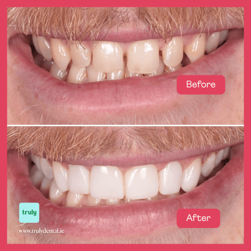 الترابط المركب