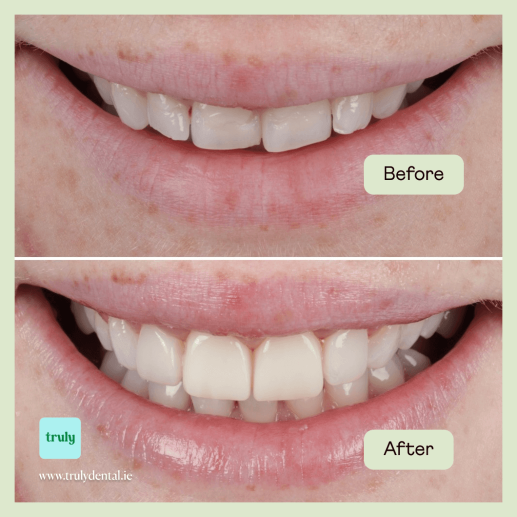 الترابط المركب