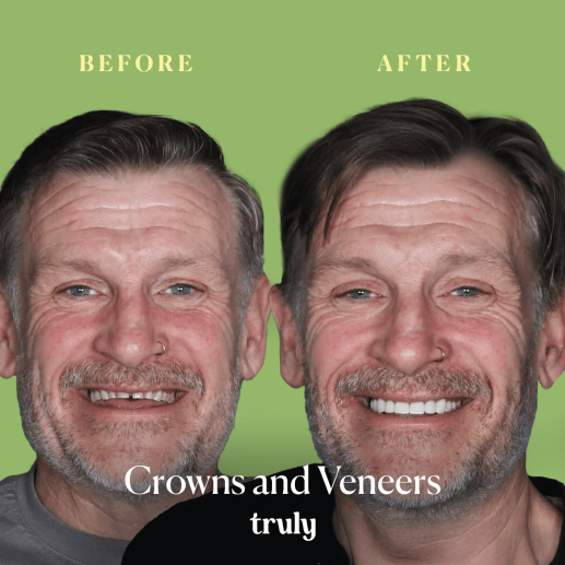 التيجان والقشرة الخشبية